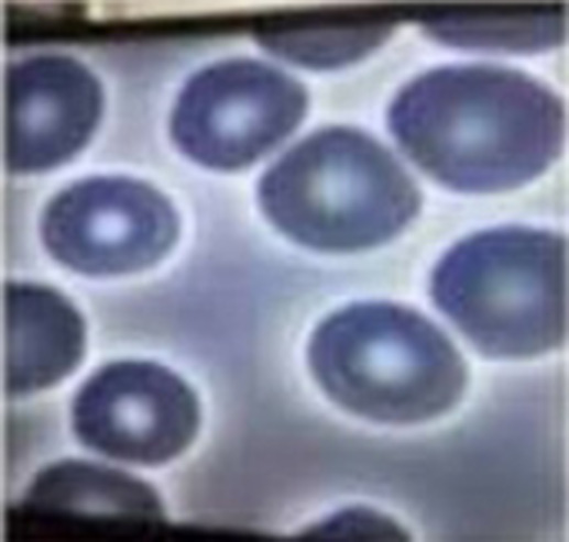 Image 2: The blood cells changed drastically over the next few days
